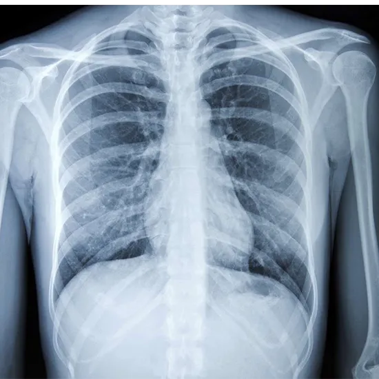 x-ray screening chest